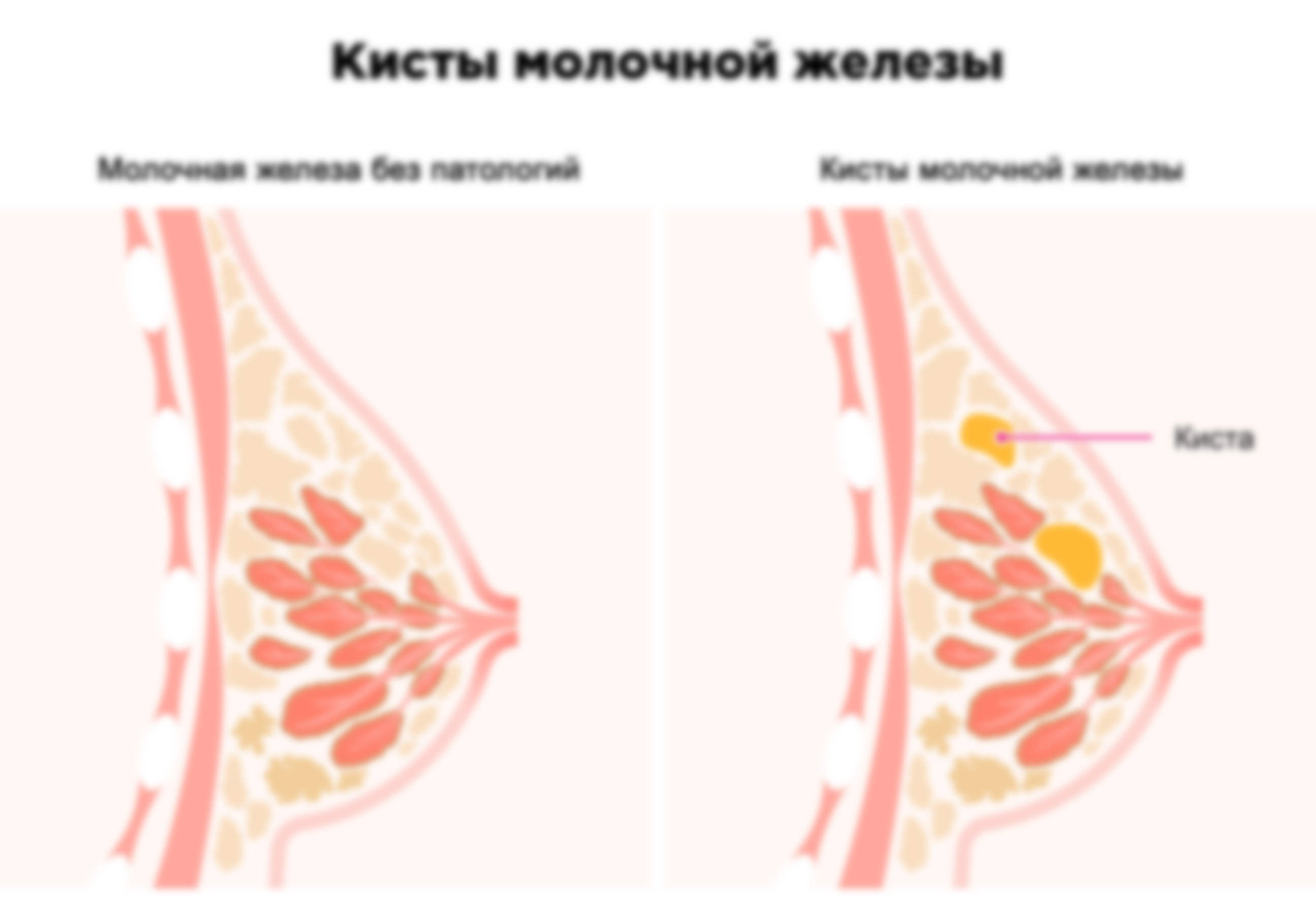 Что такое кисты молочной железы и чем лечить