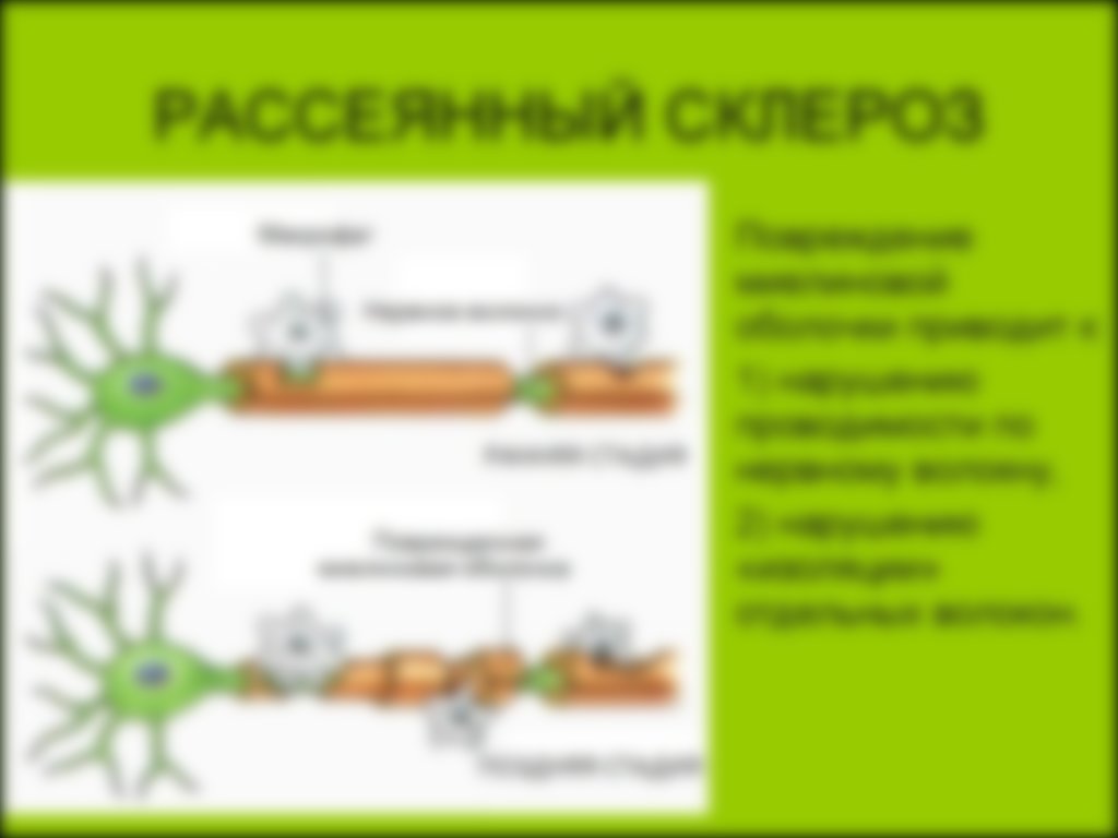 Симптомы и лечение рассеянного склероза