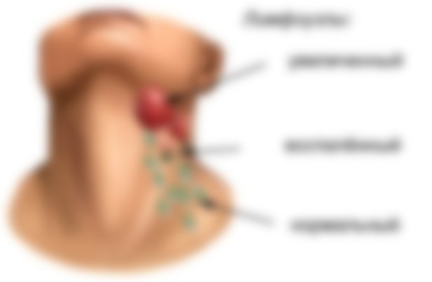Воспаление лимфоузлов при коронавирусе