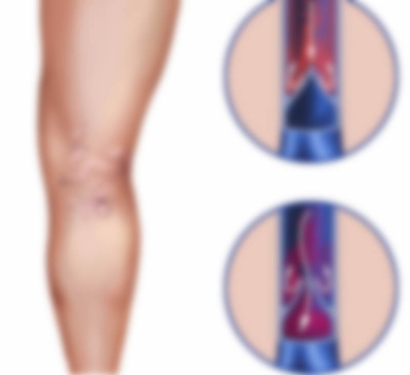 Как лечить варикозное расширение вен на ногах у женщин