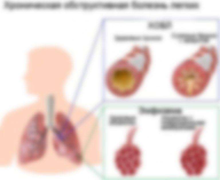 Что такое эмфизема лёгких и как ее лечить
