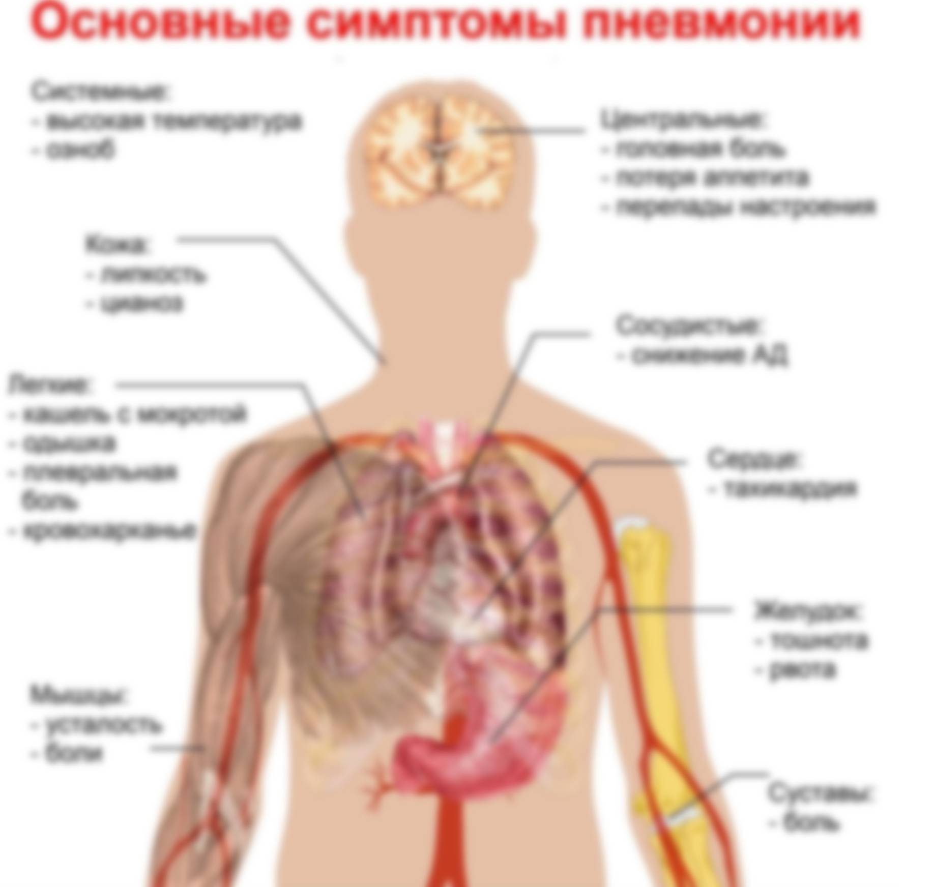 Пневмония — лечение и симптомы заболевания у взрослых и детей