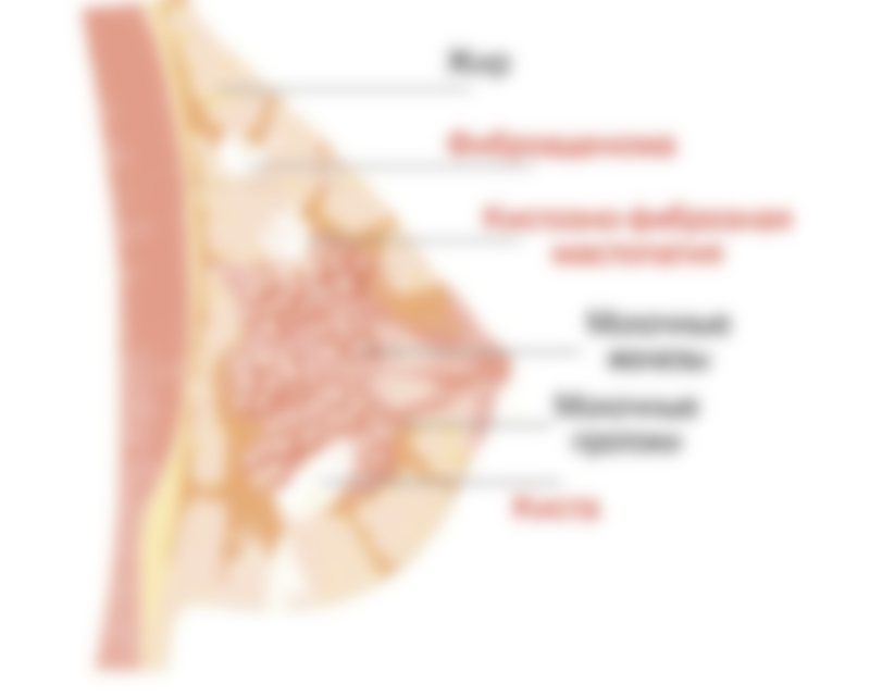 Что такое фиброзная мастопатия молочной железы и как лечить