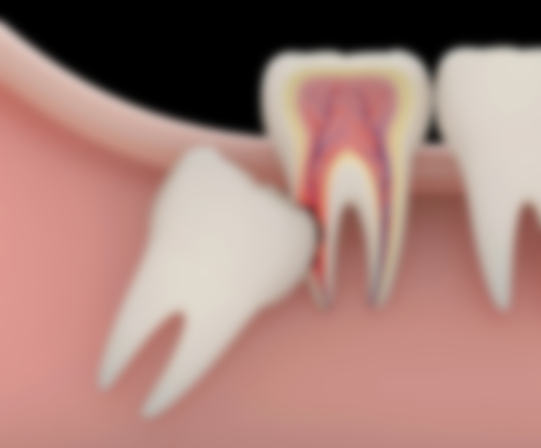 Нужно ли удалять зуб мудрости и в каких случаях